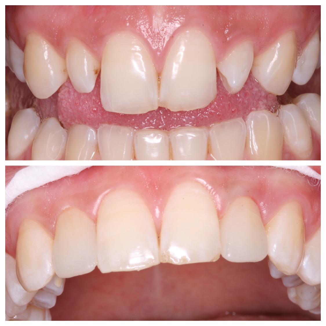 Veneers